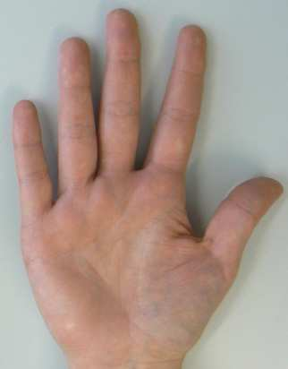 Handhabung - Stechhilfe passende Lanzetten verwenden Möglichkeit der Stechtiefeneinstellung seitlich am Finger stechen