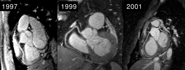 Kardiovaskuläre Magnetresonanztomographie Seite 3 Die Unterschiede zwischen MRT und Angiographie sind ganz prinzipiell: Die MRT ist eine räumliche Bildtechnik, die Angiographie eine