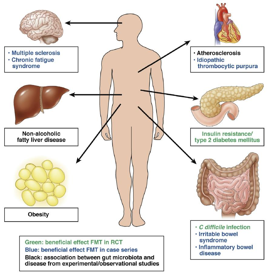 Stuhltransplantation als neue Therapieform Moayyedi et al.