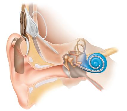 Abb. 1: CI Sprachentwicklung kongenital gehörloser Kinder bei Cochlea- Implantation nach dem 4.
