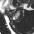 Abb.28; MRT-Bilder eines 41-jährigen Patienten mit einem anteroseptal gelegenem late-enhancement im Versorgungsgebiet der LAD. Das Infarktareal erstreckt sich von midpapillär bis apikal und macht ca.
