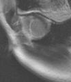 Phasen-sensitive PSIR Single Shot TrueFISP Inversion Recovery turboflash Abb.33; MRT-Bilder eines 51-jährigen Patienten mit anteriorem und anteroseptalem Myokardinfarkt nach LAD- Verschluss.