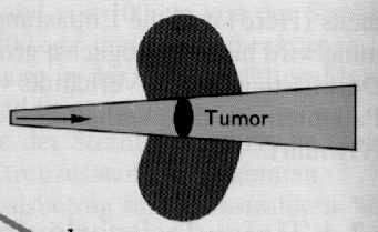 Externes Strahlenfeld Teletherapie Um die beabsichtigte Wirkung am vorgesehenen Ort (Zielvolumen) auszulösen, muss ionisierende Strahlung dort