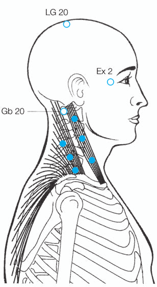 47 7 Triggerpunktsyndrome 7.1 Kopfschmerzen Die häufigsten Kopfschmerzmuskeln sind Mm. trapezius, sternocleidomastoideus (hinterer Anteil), splenius capitis, semispinalis und levator scapulae.