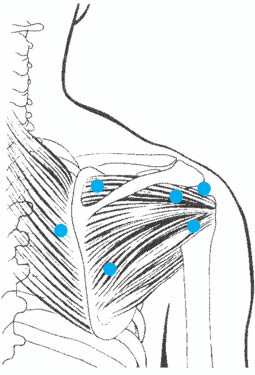50 Triggerpunktsyndrome 7.2 Nacken-Schulter-Schmerzen Die wichtigsten Verursacher von Schmerzen im Nacken-Hinterkopf-Bereich sind Mm. trapezius (Abb.