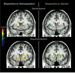 Kann man die Placebowirkung im Gehirn nachweisen? Zubieta, 2005, 25 (34); T. Wager, 2004; Lieberman et al., 2004; Benedetti et al.