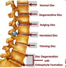 Veränderungen an der Wirbelsäule Normale Bandscheibe Degenerative Bandscheibe Bulging (=aufgequollene)