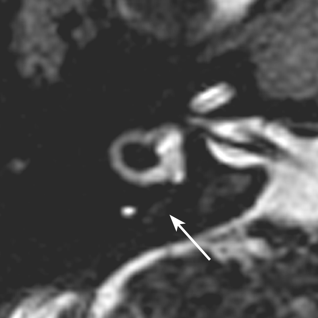 Im Gegensatz zum Aquaeductus vestibuli, der im Normalfall konstant im CT nachweisbar ist, gelingt eine Visualisierung des Ductus endolymphaticus als eine schmale, signalintense Struktur im MRT nur in