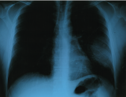 Medizinischer Fachartikel Lungeninfarkte hingegen sind schlecht oder nicht durchblutet, Tumore weisen im Unterschied zur Pneumonie ein irreguläres Durchblutungsmuster auf.