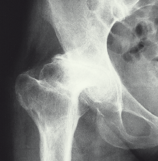 Diagnose erkrankter Gelenke Auf dem Röntgenbild ist die Knorpelschicht nicht erkennbar, sie zeichnet sich nur als Spalt zwischen dem Hüftkopf und der Hüftpfanne ab.