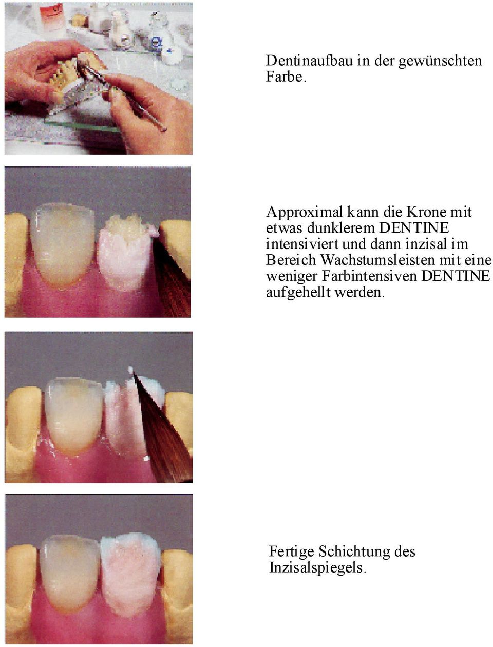 intensiviert und dann inzisal im Bereich Wachstumsleisten mit