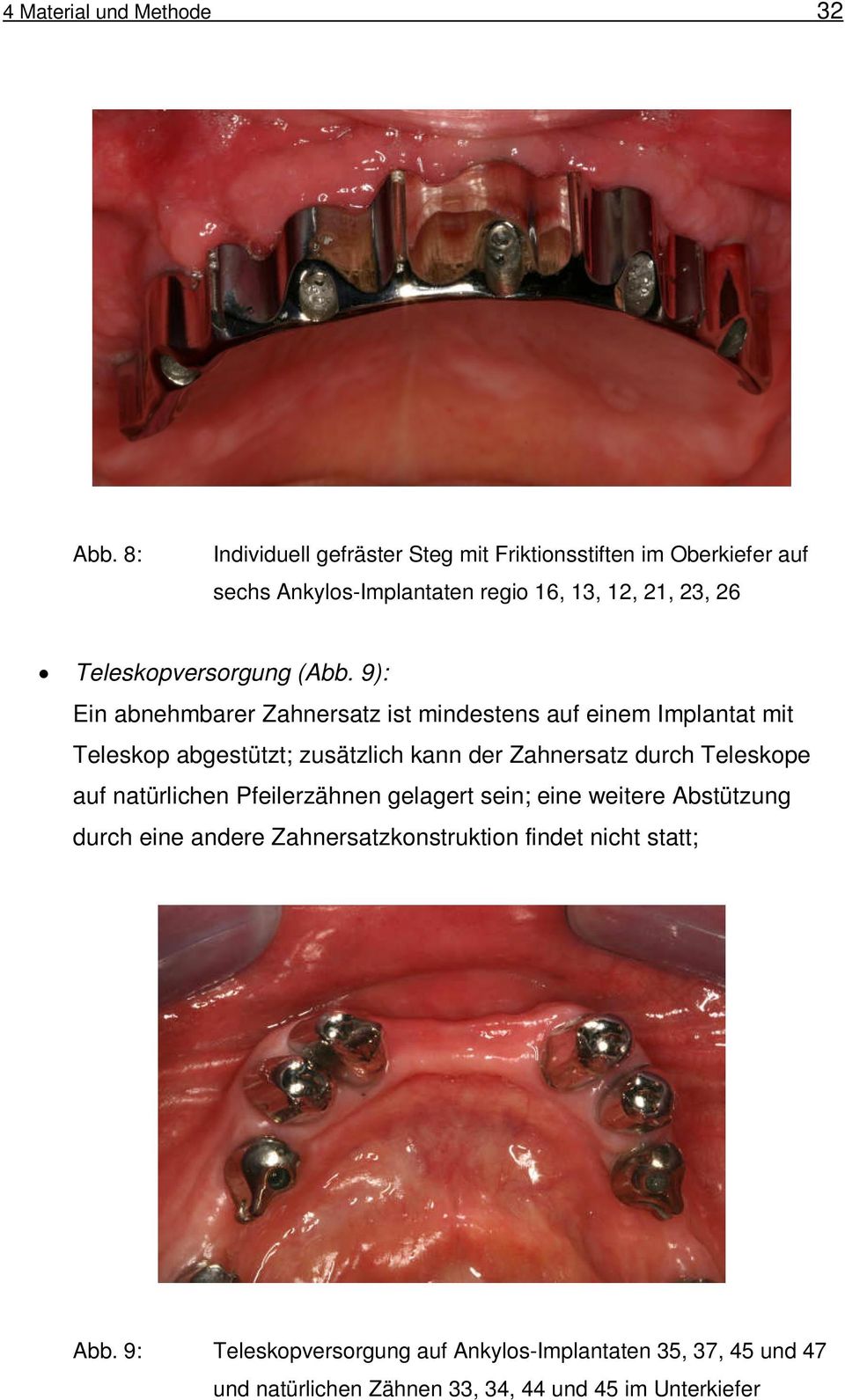 (Abb. 9): Ein abnehmbarer Zahnersatz ist mindestens auf einem Implantat mit Teleskop abgestützt; zusätzlich kann der Zahnersatz durch