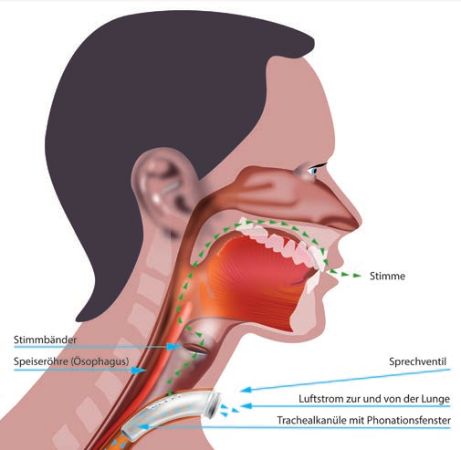 108 109 Vor Laryngektomie / Tracheotomie Nach Tracheotomie Nach Laryngektomie Nach