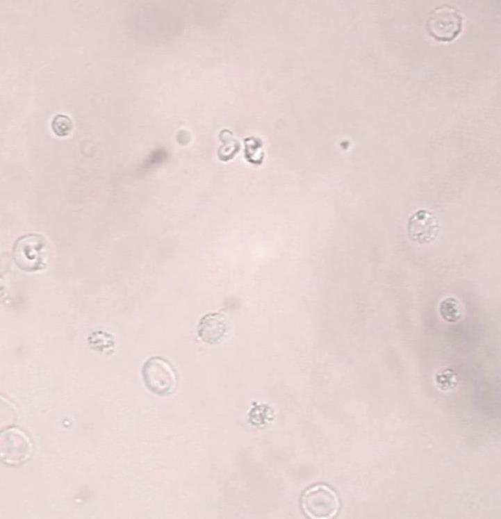 dysmorphe Erythrozyten Hellfeld-Mikroskopie Auffällig ist die vielgestaltige und mikrozytäre Form der dysmorphen Erythrozyten.