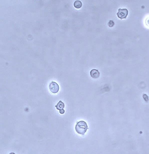 Dysmorphe Erythrozyten und Akanthozyt Phasenkontrast-Mikroskopie Dysmorphe Erythrozyten: Auffällig ist die vielgestaltige und mikrozytäre Form.