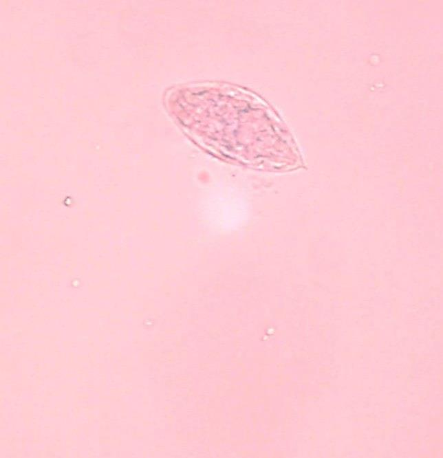 Schistosoma Ei Trematodeninfektion (Trematoden = Saugwürmer) Ei von Schistosoma haematobium Erreger der Blasen- bzw. Urogenitalbilharziose Die Eier sind sehr groß und gut zu erkennen.