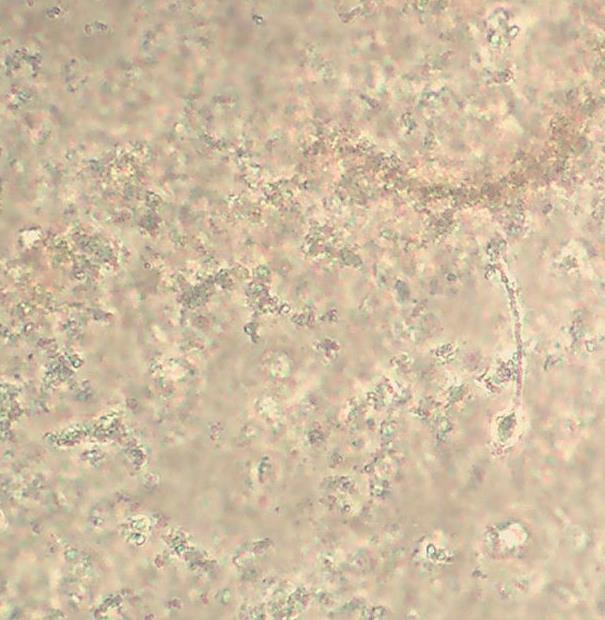 Urate amorphe Salze der Harnsäure Urate ähneln Sandkörnern. Urin ph-wert <6 Sie haben eine braune Eigenfarbe, die im Hellfeld gut zu erkennen ist.