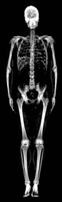 Vitamin D und Knochenhaushalt Knochendichtemessung (DXA) Dual-Röntgen-Absorptiometrie (DXA) Dauer: 5-10 Minuten Strahlenbelastung: 1-2 μsv