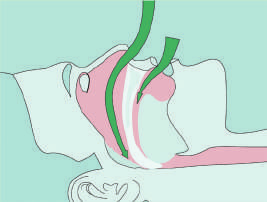 Anti-Schnarch-Schienen Unsere SomnoGuard Anti-Schnarch-Schienen verlagern den Unterkiefer und die Zunge leicht nach vorne. Sie öffnen die Atemwege und verringern bzw.