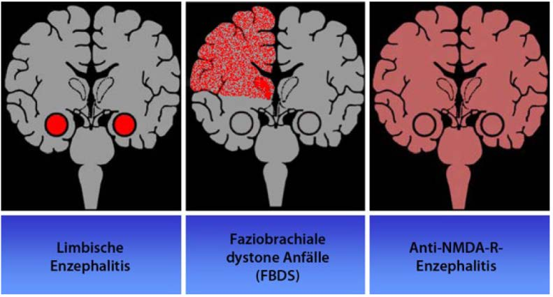 7 Nomenklatur Limbische Encephalitis ist aus neuroanatomischer Sicht unpräzise pragmatische Einteilung in paraneoplastische Encephalitis (bei Tumornachweis)
