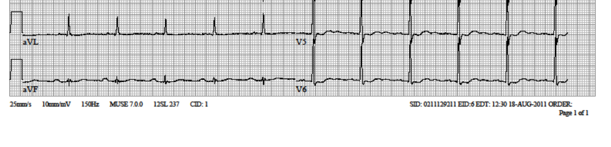 EKG 2 ICR höher!!! Verdacht auf Brugada- Syndrom!