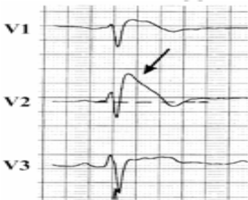 Differentialdiagnosen EKG Frühe Repolaristion RSB Akute Mykoardischämie Akute Myokarditis ARVD Rechstherzbelastung(PE, RVOT-Obstruktion bei Mediastinal- TU) Hypothermie ( Osborn Wellen)