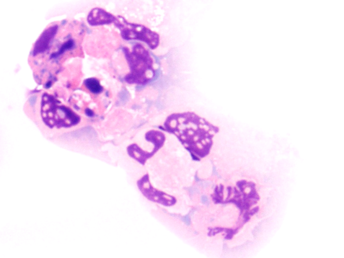 Lebende unbehandelte Leukämiezellen JQ1 behandelte Leukämiezellen in Apoptose Ein Teil der Forschungsergebnisse wurde vor Kurzem in der Fachzeitschrift Nature