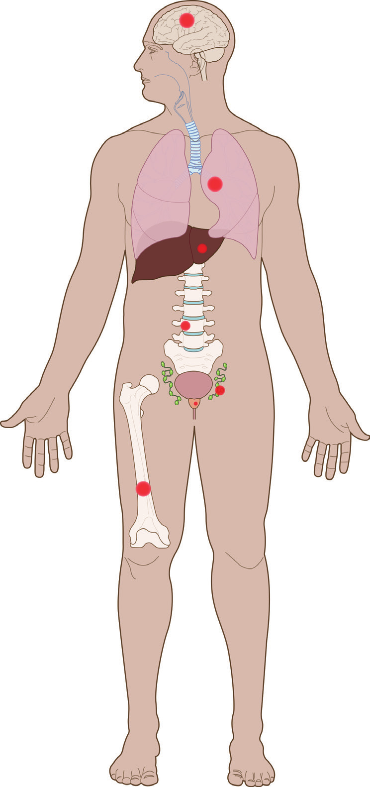 Hirnmetastase Lungenmetastase Lebermetastase Wirbelsäulenmetastase Beckenlymphknoten Prostatatumor Knochenmetastase Abb.