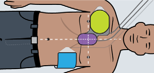 Ziehen Sie die Klebefolie vom violetten Sensor und von der grünen Elektrode ab, und bringen Sie sie am Patienten an, wie in den Abbildungen auf der Packung dargestellt.