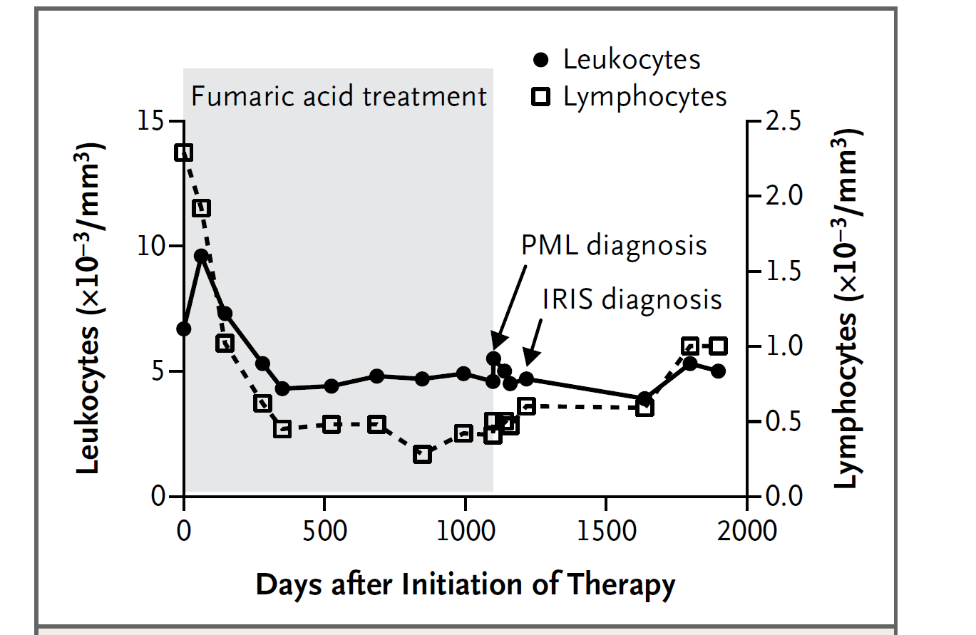 PML nach Behandlung mit Fumaderm Ermis U et al: N Engl J Med 368: 1657 1658 (2013) PML: