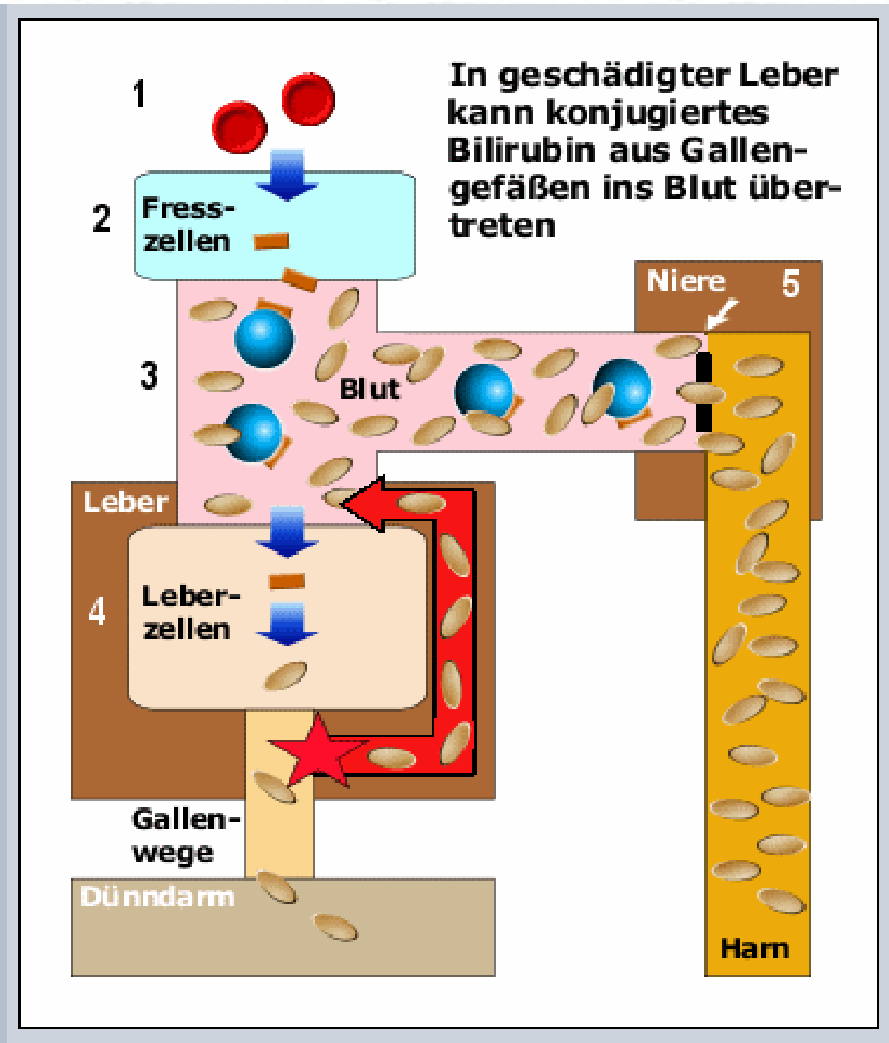 Intrahepatischer Ikterus (z.b. Hepatitis) Cholestase intrahepatisch: Blut: direktes Bilirubin evtl.