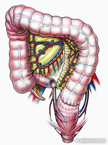 Der linke Dickdarm wird mit seiner Darmwurzel beweglich gemacht und mit dem Enddarmstumpf wieder verbunden.