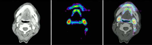 funktionelle Bildgebung F-FDG-Ganzkörperaufnahme 41 42 PE-Tomographie PE-Tomographie MRT-Aufnahme +