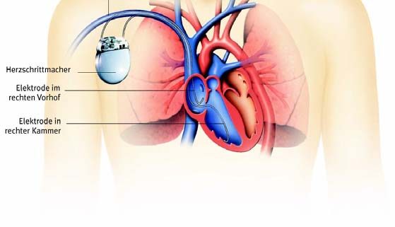 unter die Haut implantiert. Dieses Gerät wird mit einer oder zwei Elektroden durch eine Vene mit dem Herzen verbunden. Diese Elektroden dienen einerseits dazu, Schrittmacherimpulse ans Herz abzugeben.