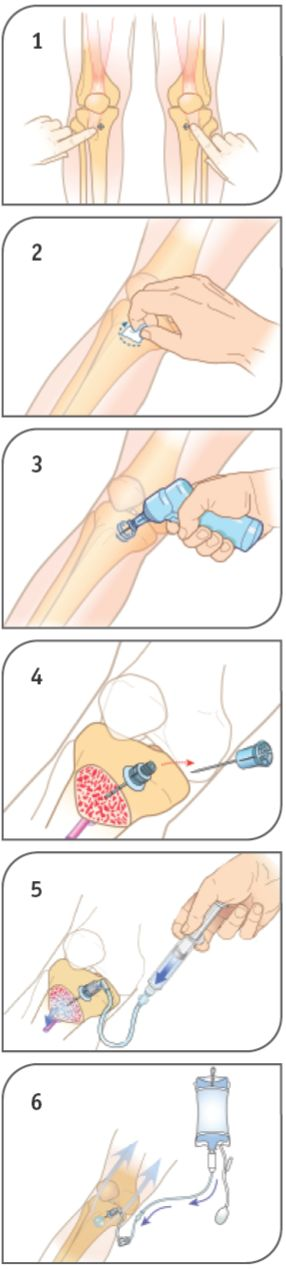 distal der Tuberositas Tibiae im Kniegelenk leicht beugen, unterpolstern bohren bis
