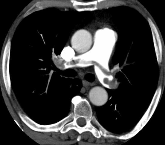 Pulmonalis-CT
