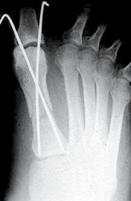 ist bei diesen Frakturen eine Operationsindikation ab einem Achsknick >10 bzw. einer Dislokation >3 4 mm gegeben [1]. Dies ist aber oftmals röntgenologisch nur schwer zu beurteilen.