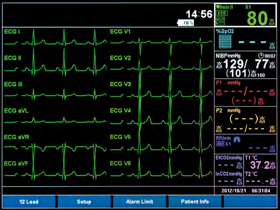12-Kanal-EKG Interpretation mit Glasgow University Algorithmus.