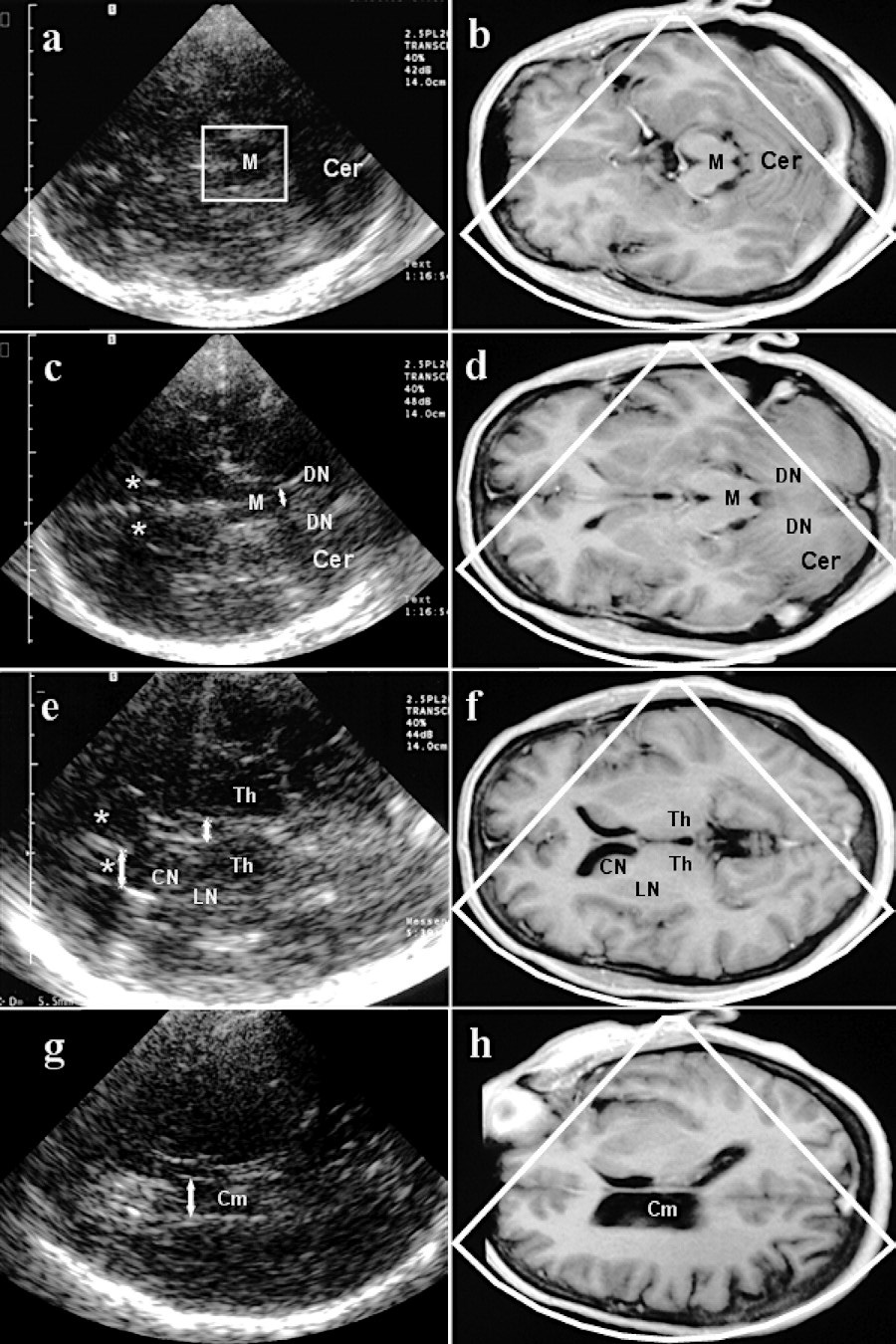 Material und Methoden Abbildung 2. Darstellung von korrespondierenden Schnittebenen im MRT (rechte Spalte) und in der transkraniellen Hirnsonographie (linke Spalte).