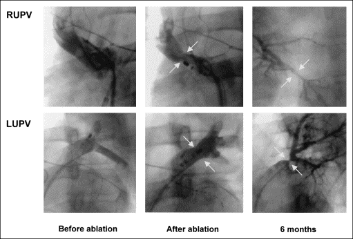 7.2 Abbildungen RSPV LSPV vor Ablation nach Ablation nach 6 Monaten Abbildung 1: PV-Angiographie : Darstellung einer PV-Stenose der rechten oberen und linken oberen PV nach segmentaler