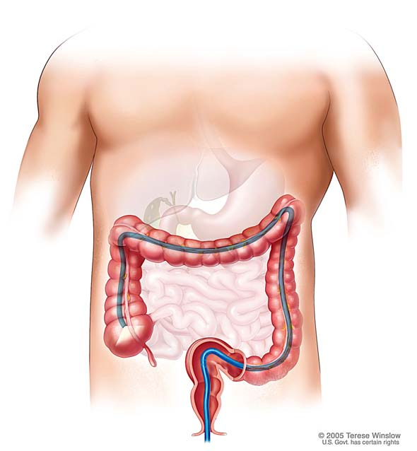 auch zur Vorsorge eine Dickdarmspiegelung (Coloileoskopie) geplant. Dieser Informa*onsbogen soll Sie vorab über die Untersuchung informieren. Dr. Grüner oder Dr.