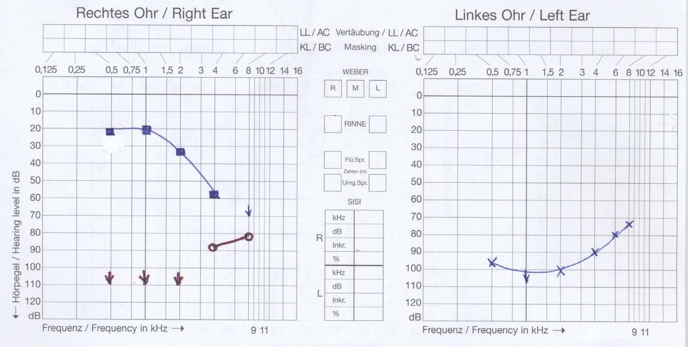 Tonaudiogramm - - Auflähkurve (Freifeld mit Hörgeräten) o-o-o rechtes Ohr (Kopfhörer) x-x-x