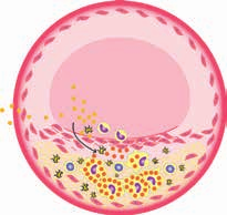 1 4 2 5 Arteriosklerose entwickelt sich langsam und führt zu einer zunehmenden Mangeldurchblutung der Gefäße.