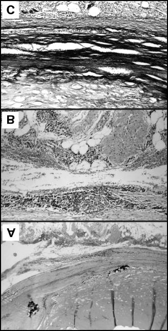 52 25-4 26-4 27-4 Abbildung 9: Mikrofotogramme verschiedener Bereiche der Wandstrukturen eines atherosklerotischen Aneurysmas (A, B, C; Präparat 21840/93; Fall 9; 73 jähriger Mann).