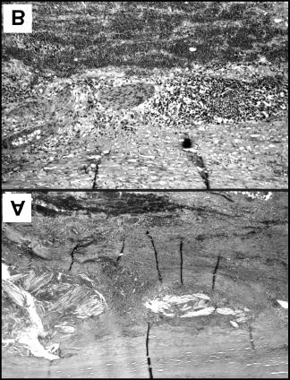 55 28-4 29-4 Abbildung 10: Mikrofotogramme verschiedener Bereiche der Wandstrukturen eines IBAA A, B. Präparat 210/95; Fall 10; 75 jähriger Mann.