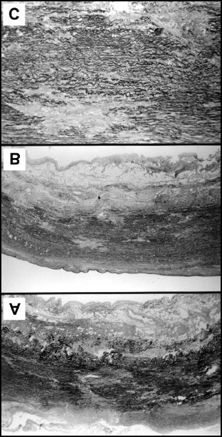 66 30-4 31-4 32-4 Abbildung 13: Mikrofotogramme verschiedener Bereiche der Wandstrukturen einer Aorta mit Medianecrosis Erdheim-Gsell (A, B, C; Präparat 24547/93; Fall 13; 62 jähriger Mann).