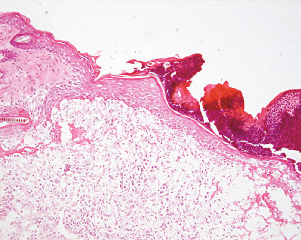 Wundschluss Nach Verwundung der Haut beginnen sich Keratinozyten am Wundrand zu teilen und zwischen Fibrinpfropf und Matrix in die Wunde einzuwandern (Abb.25).