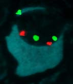 1) CCND2 overexpression without 11q13 +,