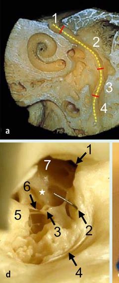 petrosi (superficialis) majoris, 4 Pars tympanica des Canalis facialis.