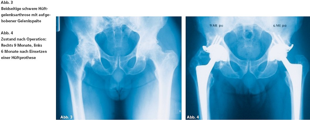 Wie lange hält eine Hüftprothese? Wie lange eine Hüftprothese hält, ist auch abhängig von der Beanspruchung. Die durchschnittliche Lebensdauer einer Hüftprothese beträgt 15 Jahre.